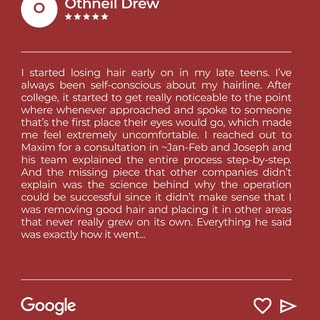 One year after 3,272 FUE grafts, this patient achieved a refreshed hairline with improved coverage t
