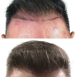 What a hair restoration can do for your overall appearance. A fuller, well-designed hairline can com