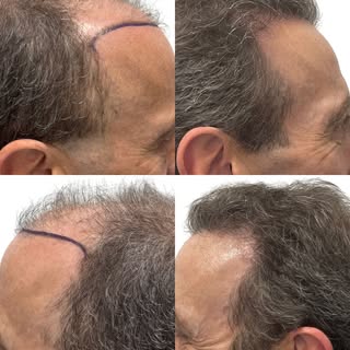 Filling in your corners can completely change the way your face looks. When the corners recede, the 