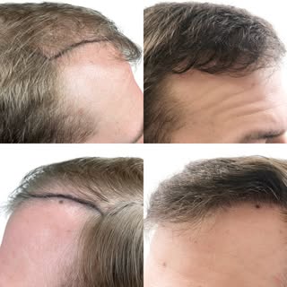 A hair transplant can change much more than just the amount of hair you have. The hairline acts like