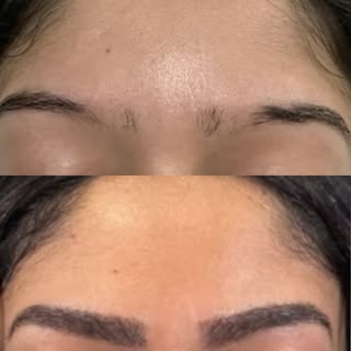 This eyebrow hair transplant before and after shows just how much your eyebrows can influence your o