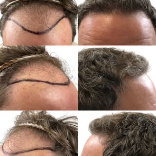 Here’s what 3,099 FUE grafts can achieve. Strategically placed grafts can restore natural density, r