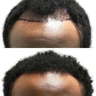 Now, on paper, he’s 32 years old. But with those 3,000 grafts, we just turned back the clock!