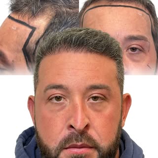 We love our clients, and our reviews speak for themselves. Very few hair transplant providers have e