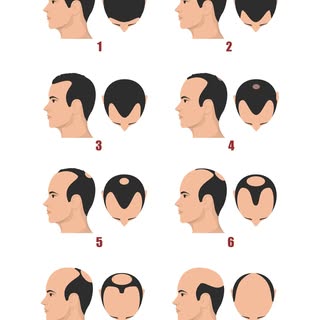 Male pattern hair loss doesn't happen overnight. It follows a predictable progression, beginning wit