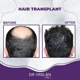 Good results from our clinic. 💯

📩 info@drarslanhair.com
📍Harbiye, Abdi Ipekçi Cd. Kızılkaya Apt 