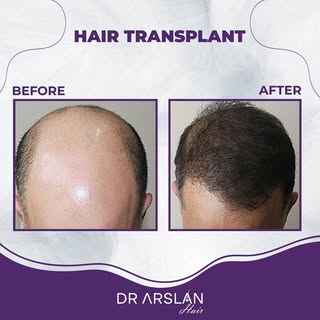 Fast and effective results. 👍🏻💉

📩 info@drarslanhair.com
📍Harbiye, Abdi Ipekçi Cd. Kızılkaya Ap