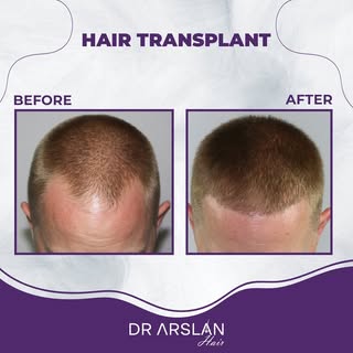 Fast results. 💯✨

📩 info@drarslanhair.com
📍Harbiye, Abdi Ipekçi Cd. Kızılkaya Apt D:No:59 Daire:0