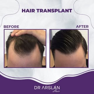 Fast and excellent results. 💯

📩 info@drarslanhair.com
📍Harbiye, Abdi Ipekçi Cd. Kızılkaya Apt D: