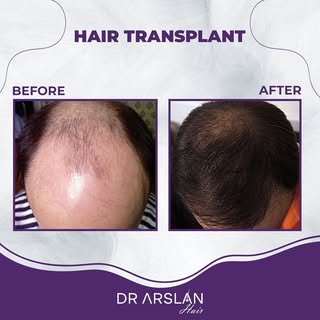You can easily have lush hair with the hair transplant procedure performed in our clinic. 💯

📩 inf