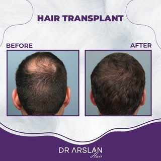 a successful before after. ✨💯

📩 info@drarslanhair.com
📍Harbiye, Abdi Ipekçi Cd. Kızılkaya Apt D: