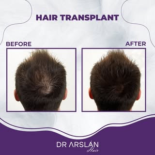 Get fast results with hair transplant. 💯

📩 info@drarslanhair.com
📍Harbiye, Abdi Ipekçi Cd. Kızıl