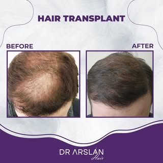 Fast results in a short time. 👍🏻✨

📩 info@drarslanhair.com
📍Harbiye, Abdi Ipekçi Cd. Kızılkaya A