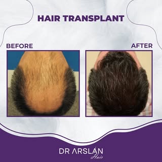 Thanks to hair transplant, you can get rid of your sparse hair quickly and have lush hair. 💯👍🏻

�