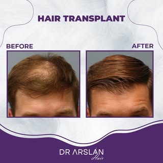 Get rid of sparse hair by achieving close to 100% success with our hair transplant procedure. ✨💯

�