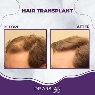 Another quick result. 💯✨

📩 info@drarslanhair.com
📍Harbiye, Abdi Ipekçi Cd. Kızılkaya Apt D:No:59