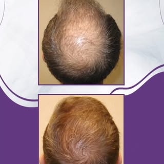 fast and successful results 💯

📩 info@drarslanhair.com
📍Harbiye, Abdi Ipekçi Cd. Kızılkaya Apt D: