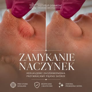 ✨ Pierwszy zabieg – pierwsze efekty!

Na zdjęciu efekt już po JEDNYM zabiegu laserowego zamykania na