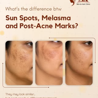 Sun spots, melasma, and post-acne marks may look similar—but they are not the same. 👀

Each conditi
