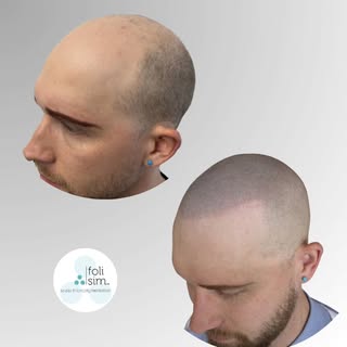 Back in action with a fresh new look! 💥

​An incredible Scalp Micropigmentation transformation comp