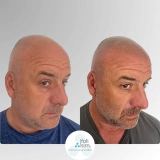 The best Scalp Micropigmentation is the kind no one notices. 🙌

​For clients with salt and pepper h