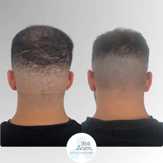 Tired of FUE Scars Affecting Your Confidence? SMP Can Help! 💥

​For many, a Follicular Unit Extract