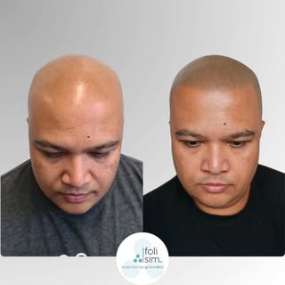 It’s a common question: "Can SMP look truly natural?" 🤔

​The answer is a YES. Check out this resul