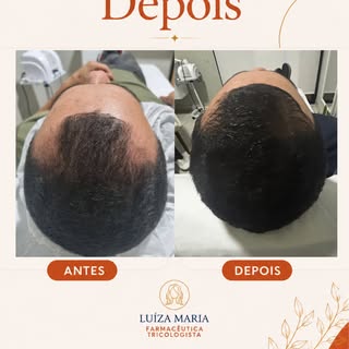 Em tratamento 

Realizado sessões de laser, led, Microagulhamento, uso de suplementos, tônicos e sha