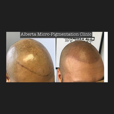 Alberta Micro-Pigmentation Clinic - Scalp Micro-Pigmentation (SMP)