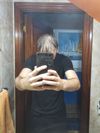 18-Year-Old Losing Hair Rapidly Over One Year: Advice?