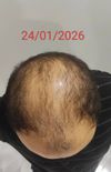 &ldquo;80-Day Hair Regrowth Journey – Early Signs of Progress?&rdquo;