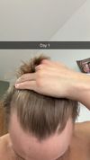 Considering Finasteride for Receding Hairline at 22