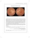 Fundus Changes in Systemic Lupus Erythematosus