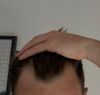 Temple hair loss - looking for guidance