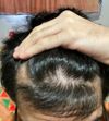 20M: 6 Months on Minoxidil, Starting Finasteride – Will Hair Regrow?