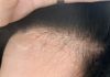 Help: Digital Perm while Thinning Hairline