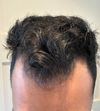 M26 - Day 1 Fin + Min Hairloss Journey - Updating weekly for 6 months