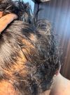 Seeking Advice for Hair Thinning at 19, Ongoing Since 16