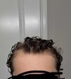 Should I talk to my Doctor about finasteride? 18yo