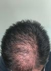 18M, should i hop on oral finasteride or continue what im doing rn?