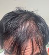 Hair still thin after min+fin and gair transplant
