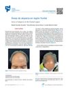 Alopecia Areas in the Frontal Region