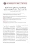 Spotted Lunula in Alopecia Areata: Clinical and Onychoscopic Features of an Unusual Sign